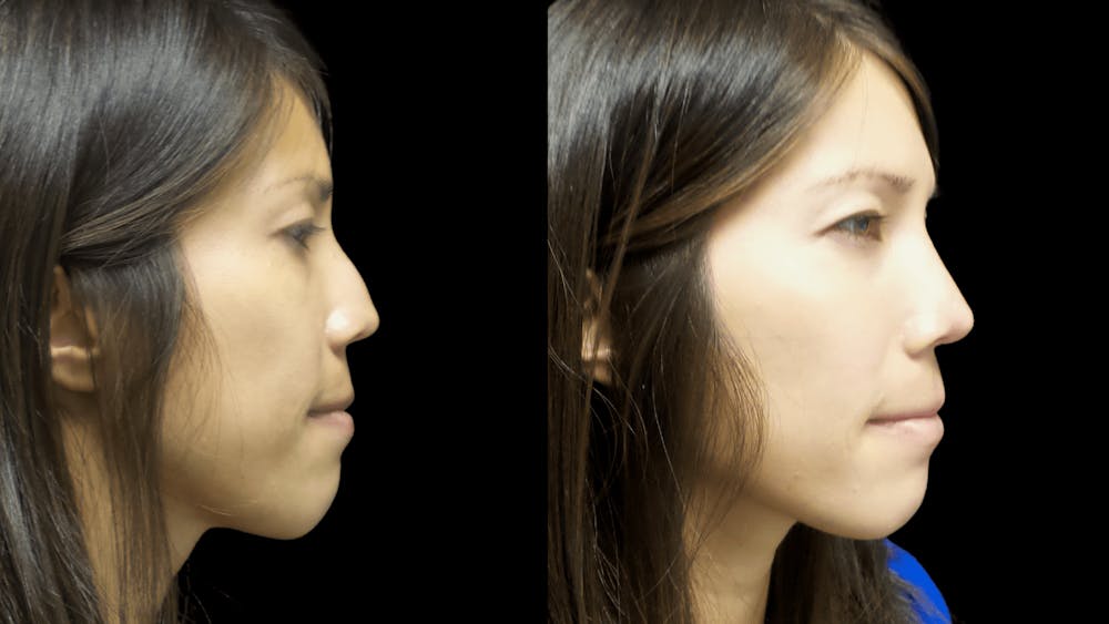 Before and after Asian Rhinoplasty in Hawaii with Dr. Shim Ching