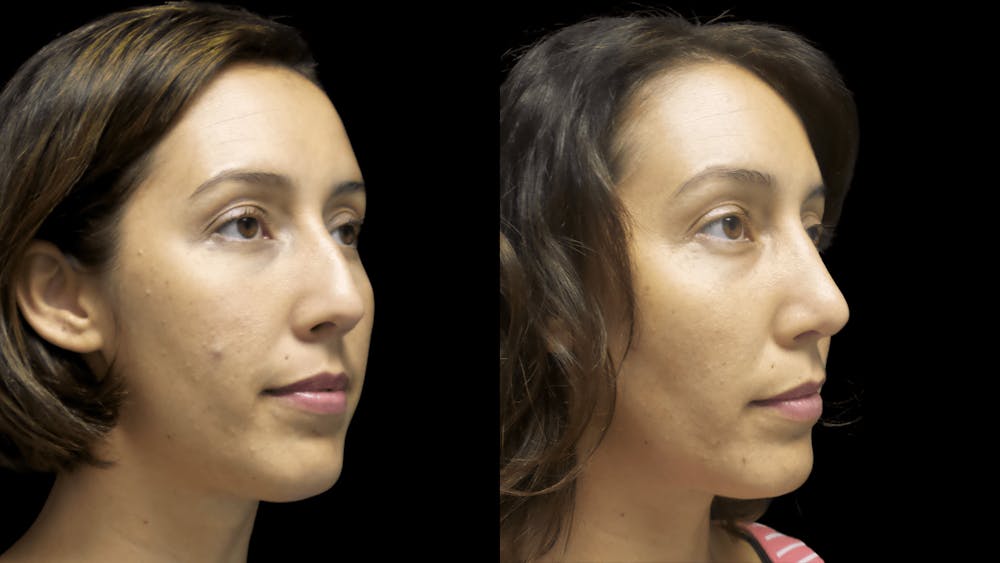 Rhinoplasty Before & After Gallery - Patient 38290642 - Image 2