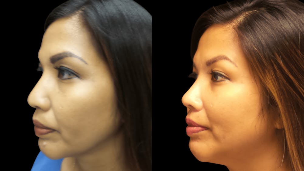 Before and after Asian Rhinoplasty in Hawaii with Dr. Shim Ching