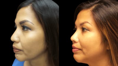 Rhinoplasty Before & After Gallery - Patient 38290653 - Image 1