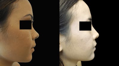 Rhinoplasty Before & After Gallery - Patient 38290649 - Image 2