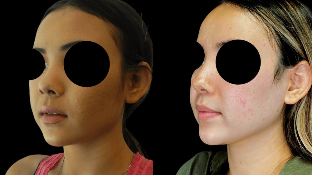 Rhinoplasty Before & After Gallery - Patient 38290649 - Image 3