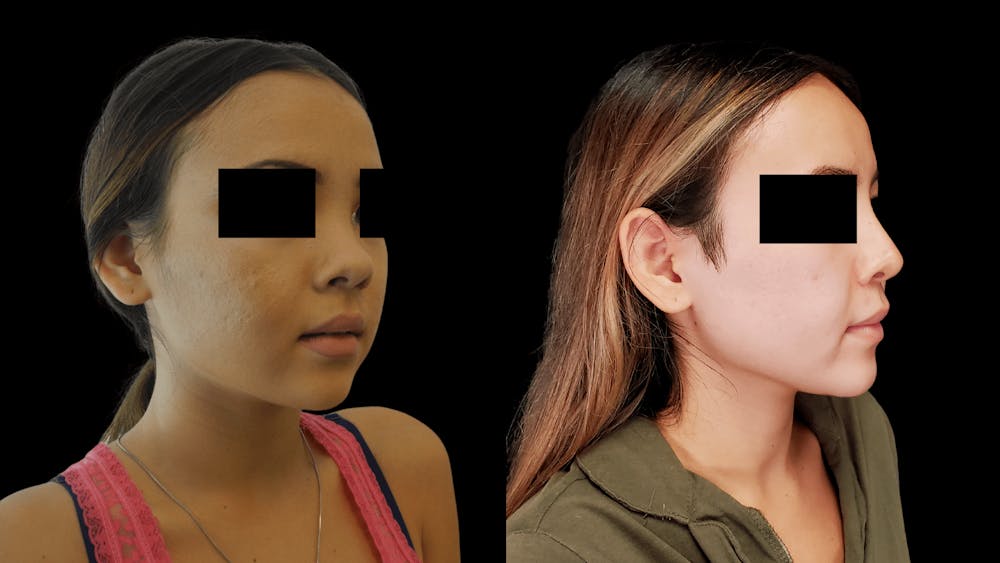 Rhinoplasty Before & After Gallery - Patient 38290649 - Image 4