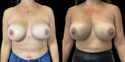 Breast Augmentation Revision Before & After Gallery - Patient 120354356 - Image 1