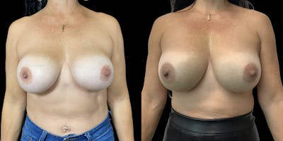 Breast Augmentation Revision Gallery - Patient 120354356 - Image 1
