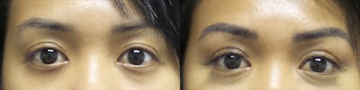 Asian Eyelid Before & After Gallery - Patient 120771426 - Image 1
