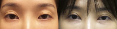 Asian Eyelid Before & After Gallery - Patient 120771427 - Image 1