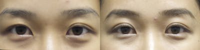 Asian Eyelid Before & After Gallery - Patient 120771428 - Image 1