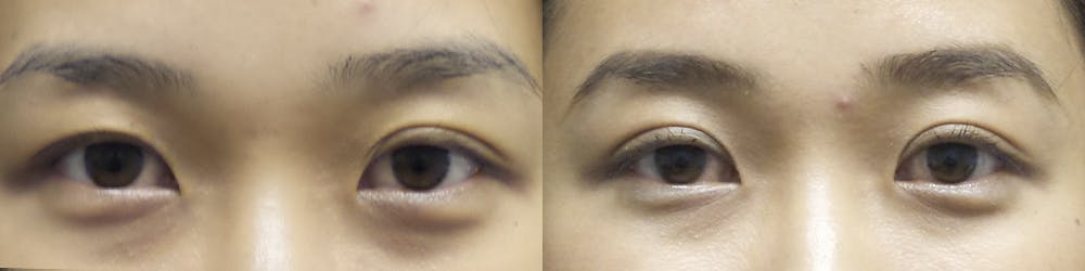 Asian Eyelid Gallery - Patient 120771428 - Image 1