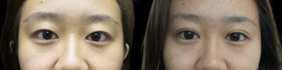Asian Eyelid Before & After Gallery - Patient 120771429 - Image 1