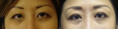 Asian Eyelid Before & After Gallery - Patient 120771430 - Image 1