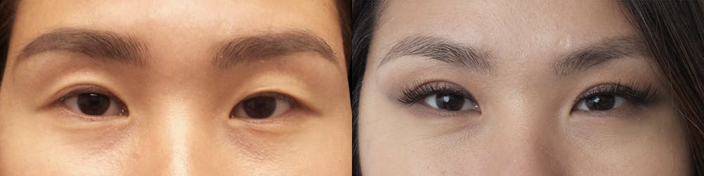 Asian Eyelid Before & After Gallery - Patient 120771431 - Image 1