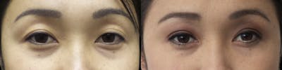 Asian Eyelid Before & After Gallery - Patient 120771432 - Image 1