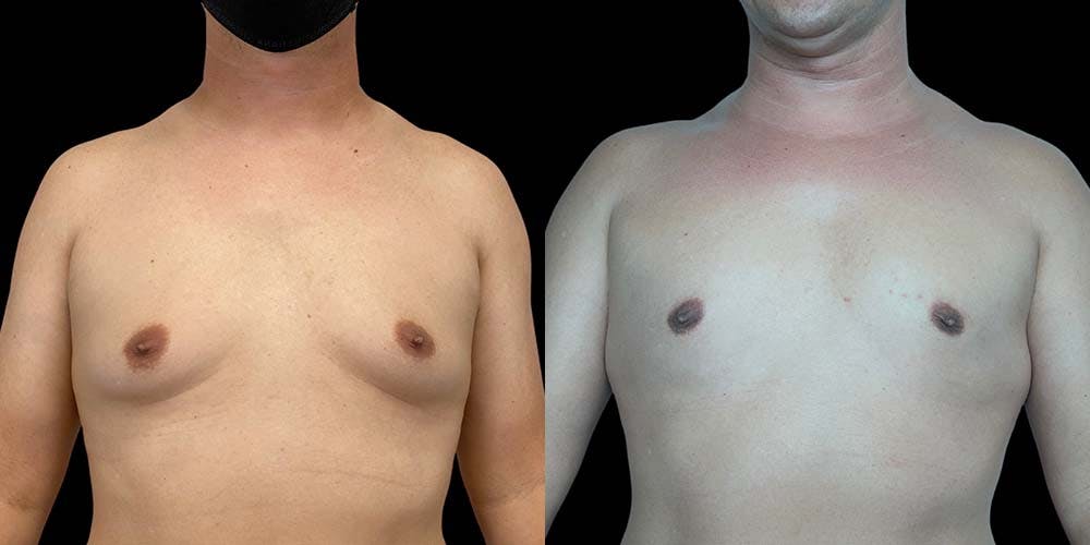 Gynecomastia Before & After Gallery - Patient 121439322 - Image 1