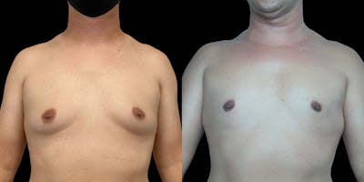 Gynecomastia Before & After Gallery - Patient 121439322 - Image 1