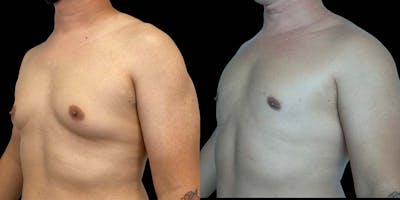 Gynecomastia Before & After Gallery - Patient 121439322 - Image 2