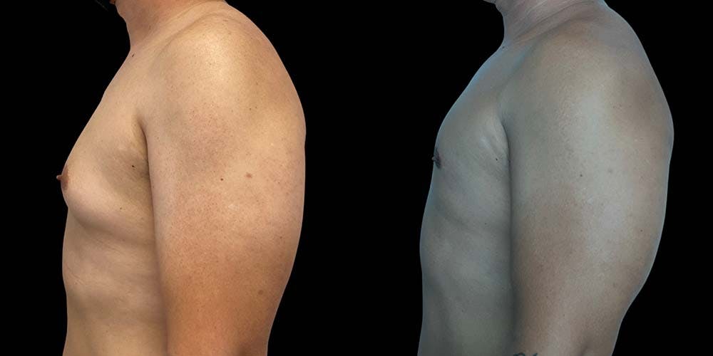 Gynecomastia Before & After Gallery - Patient 133783 - Image 3