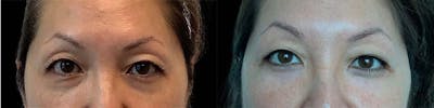 Eyelid Surgery Before & After Gallery - Patient 121439327 - Image 1