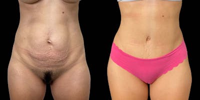 Tummy Tuck Before & After Gallery - Patient 121439356 - Image 1