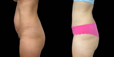 Tummy Tuck Before & After Gallery - Patient 121439356 - Image 2