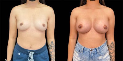 Breast Augmentation Gallery - Patient 121744135 - Image 1