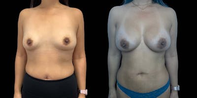 Breast Augmentation Before & After Gallery - Patient 121744136 - Image 1
