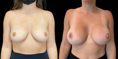 Breast Augmentation Before & After Gallery - Patient 121744137 - Image 1