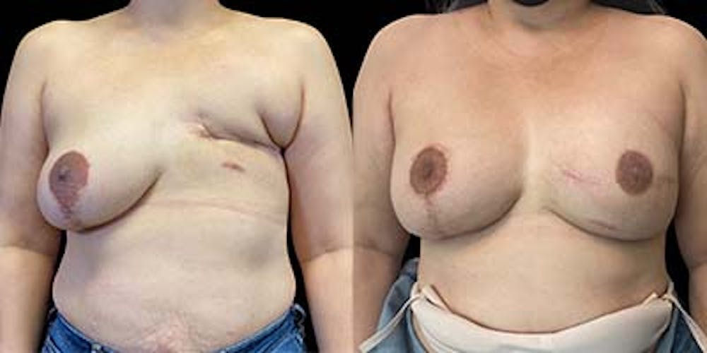Breast Reconstruction Before & After Gallery - Patient 121869450 - Image 1