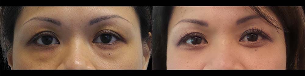 Eyelid Surgery Before & After Gallery - Patient 121871856 - Image 1