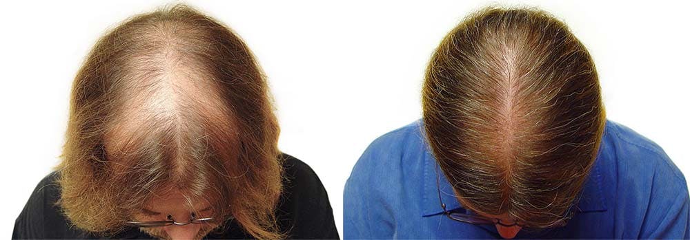 Hair Restoration Before & After Gallery - Patient 122078448 - Image 1