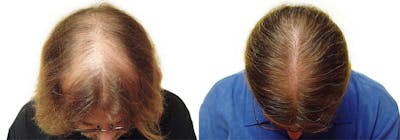 Hair Restoration Before & After Gallery - Patient 122078448 - Image 1