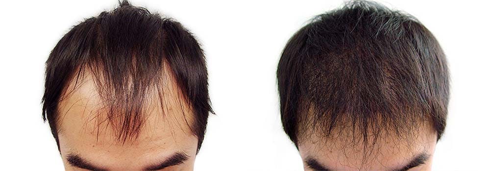 Hair Restoration Before & After Gallery - Patient 122106010 - Image 1