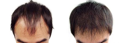 Hair Restoration Before & After Gallery - Patient 122106010 - Image 1