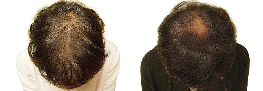 Hair Restoration Before & After Gallery - Patient 122106011 - Image 1