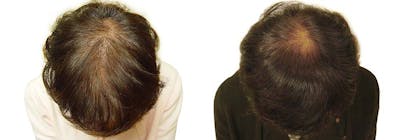 Hair Restoration Before & After Gallery - Patient 122106011 - Image 1