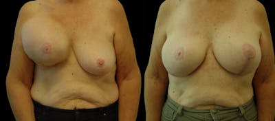 Breast Reconstruction Before & After Gallery - Patient 122890053 - Image 1