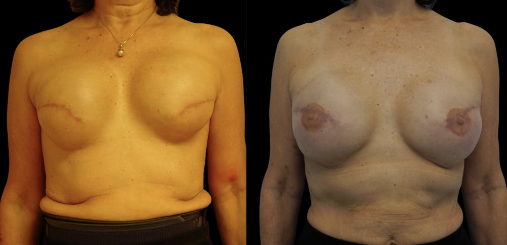 Breast Reconstruction Before & After Gallery - Patient 122890068 - Image 1