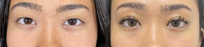 Asian Eyelid Before & After Gallery - Patient 122890604 - Image 1