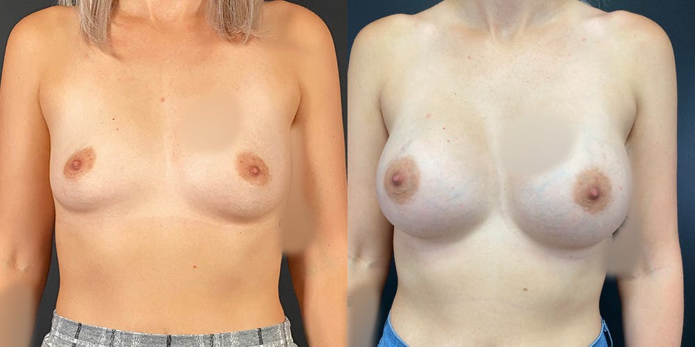 Breast Augmentation Before & After Gallery - Patient 55272483 - Image 1