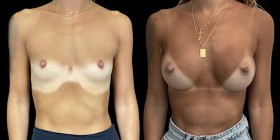 Breast Augmentation Before & After Gallery - Patient 120354324 - Image 1
