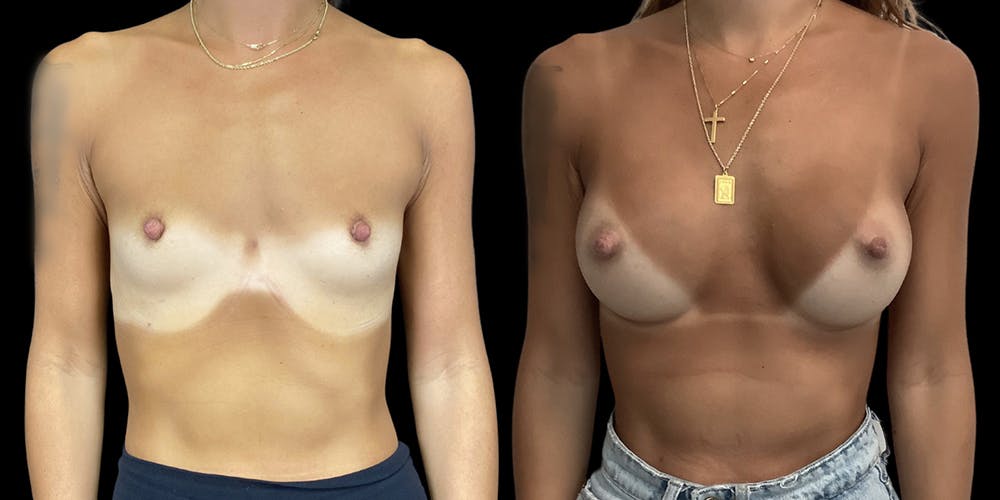 Breast Augmentation Gallery - Patient 120354324 - Image 1