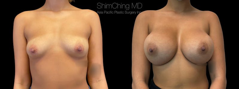 Breast Augmentation results in Honolulu with Dr. Shim Ching