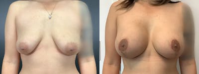 Breast Lift Before & After Gallery - Patient 102905914 - Image 1