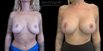 Breast Lift with Implants Before & After Gallery - Patient 38290666 - Image 1