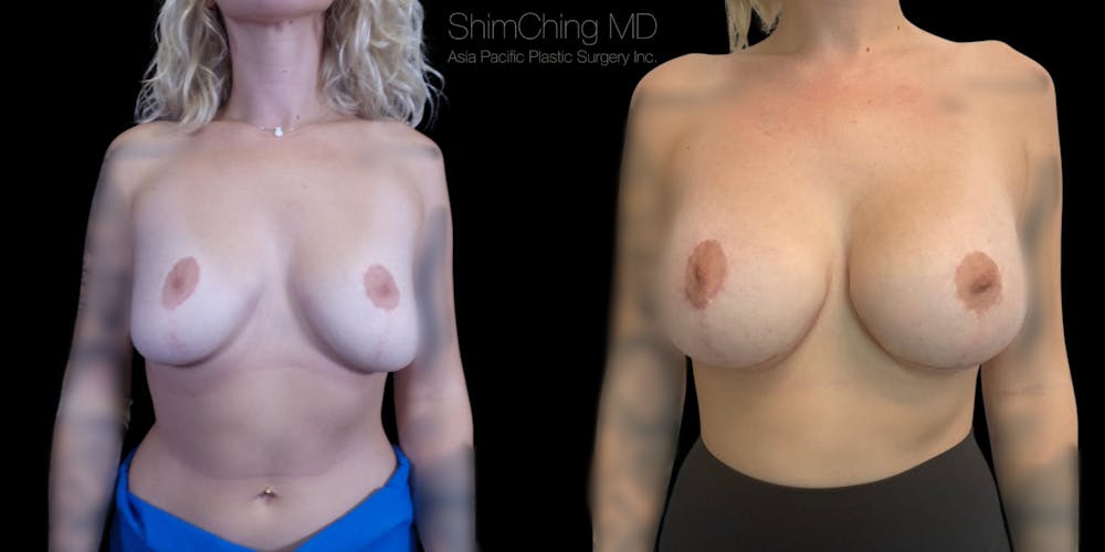Breast Lift Before & After Gallery - Patient 183956 - Image 1