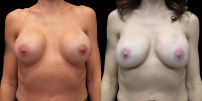 Breast Augmentation Revision Gallery - Patient 56175577 - Image 1