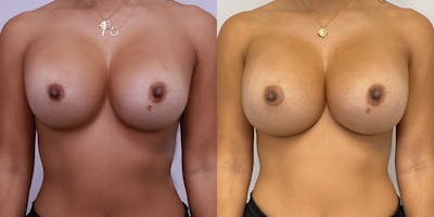 Breast Augmentation Revision Before & After Gallery - Patient 56143249 - Image 1