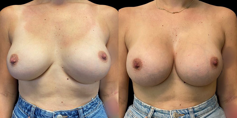 Breast Augmentation Revision Before & After Gallery - Patient 56142675 - Image 1