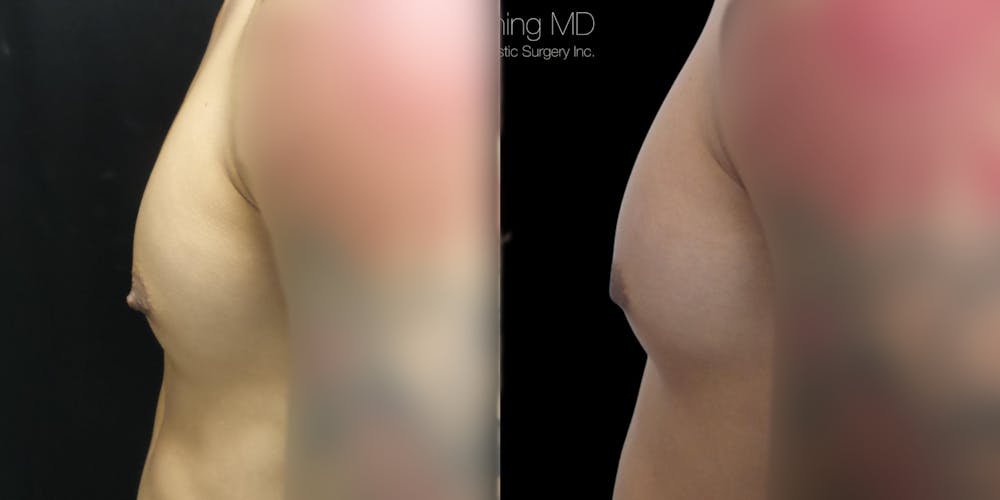 Nipple Reduction Before & After Gallery - Patient 38290689 - Image 1