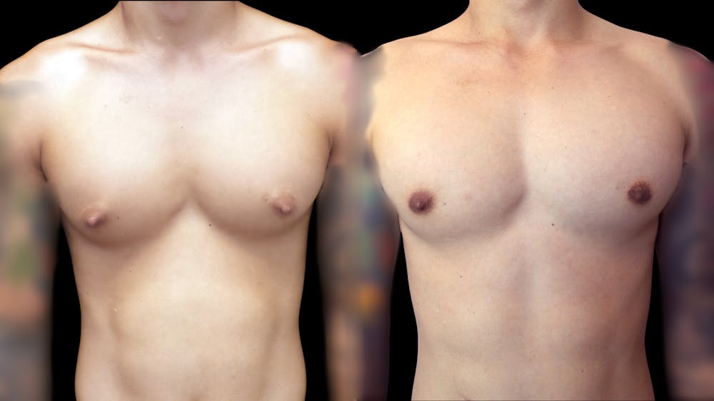 Gynecomastia Before & After Gallery - Patient 54869435 - Image 1